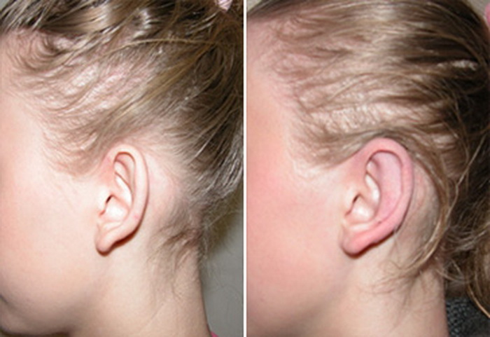 Фото до и после: пластика ушей